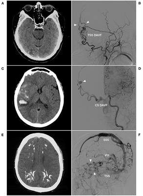 Is the Middle Meningeal Artery the Optimal Path for Dural Arteriovenous Fistula Embolization?